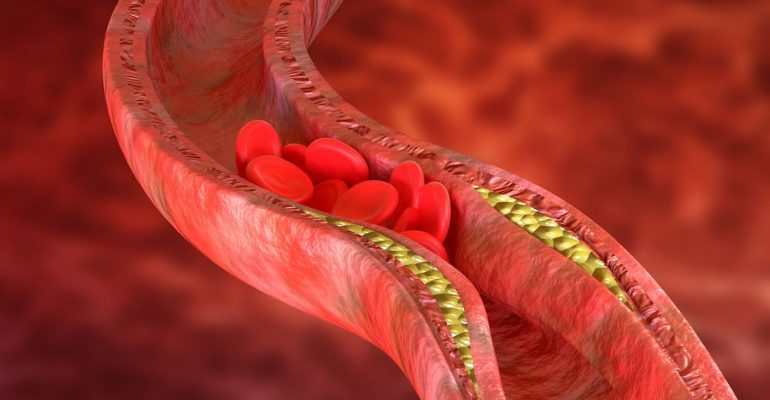 Ateroskleroza je suženje bilo koje arterije formiranjem pločice – ateroma uzrokovano: pušenjem, dijabetesom, hipertenzijom, hiperlipidemijom, fizičkom neaktivnošću, nasleđem.