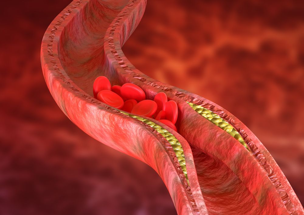 Ateroskleroza je suženje bilo koje arterije formiranjem pločice – ateroma uzrokovano: pušenjem, dijabetesom, hipertenzijom, hiperlipidemijom, fizičkom neaktivnošću, nasleđem.