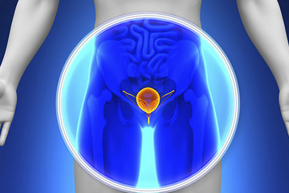 Karcinom prostate je maligni tumor žlezdanog tkiva prostate, koji daje slične simptome kao i benigna hiperplazija prostate. Pravilna dijagnoza je neophodna obzirom na različit ishod ovih bolesti.