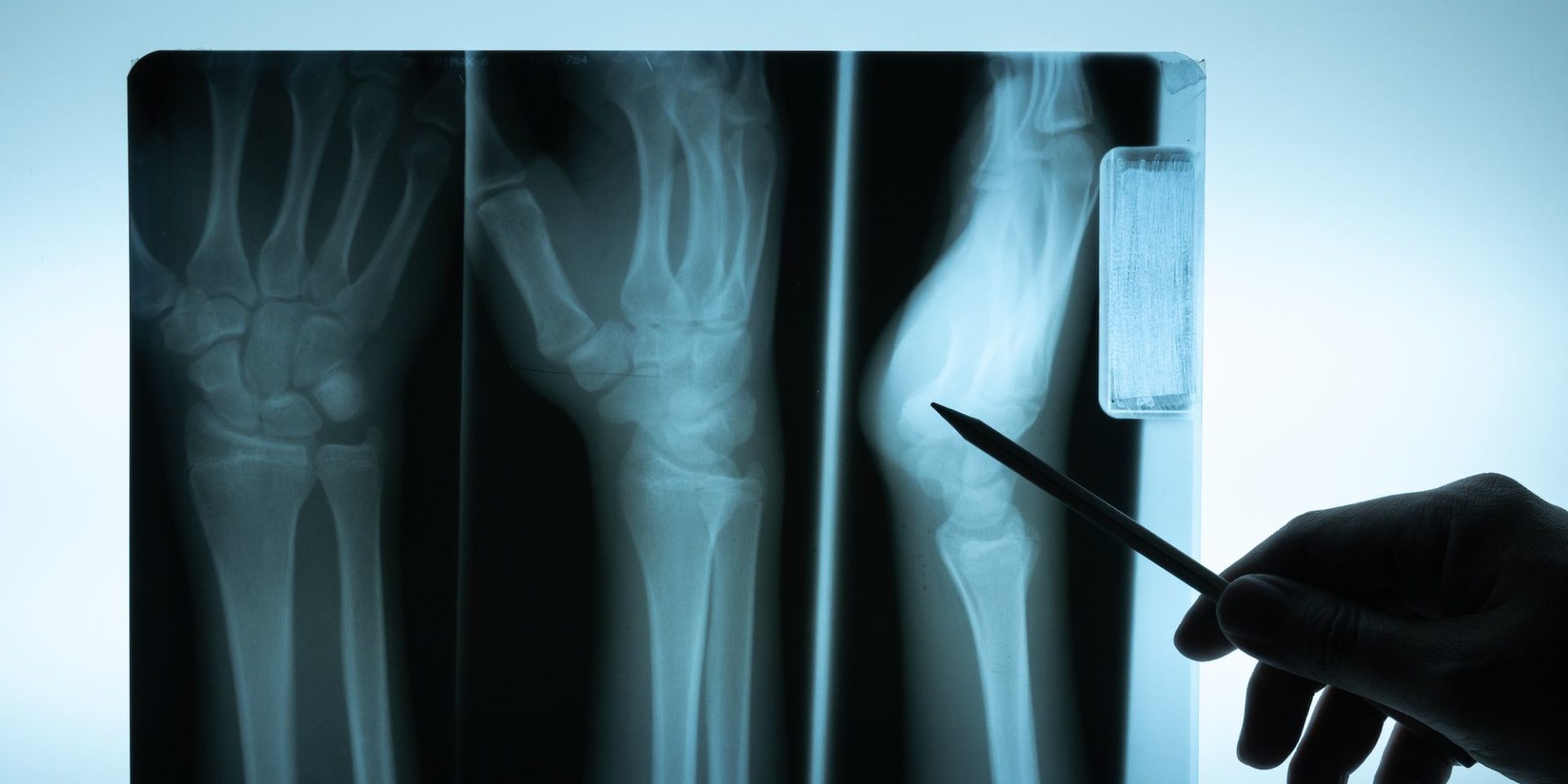 Radiografija je bezbolna i neinvazivna dijagnostička metoda koja se zasniva na primeni X zraka za snimanje različitih delova tela i organa.