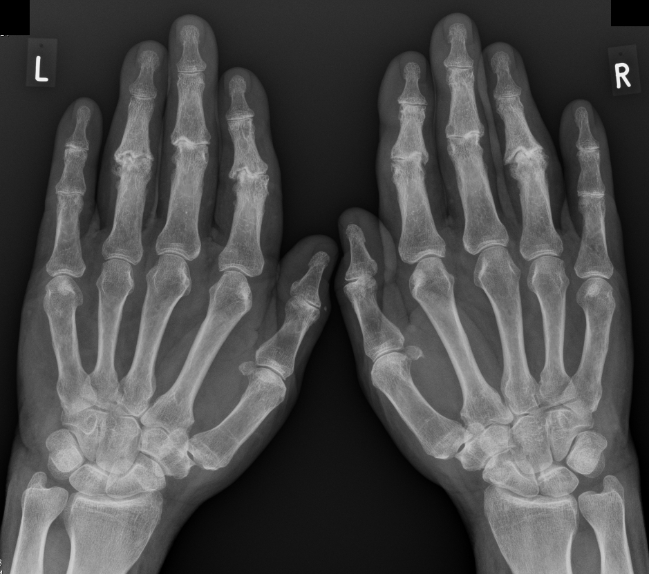 artroza u rukama