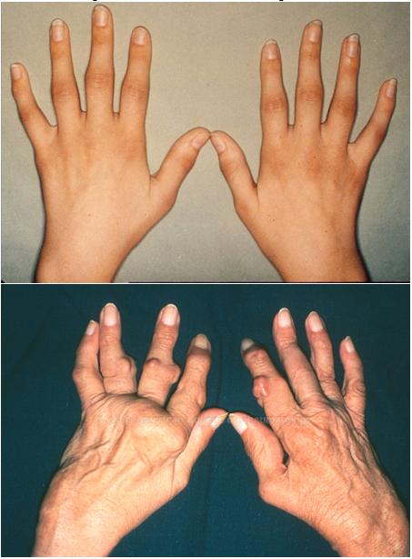 artritis prstiju)